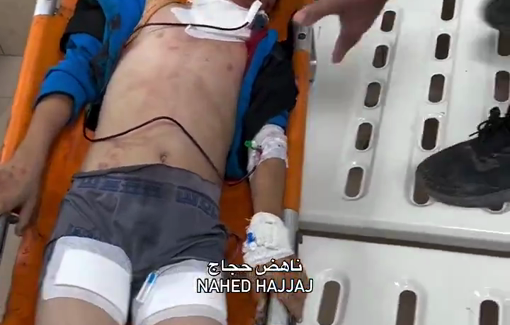 Thumbnail preview image for the video titled: Child injured by Israeli assault on Nuseirat