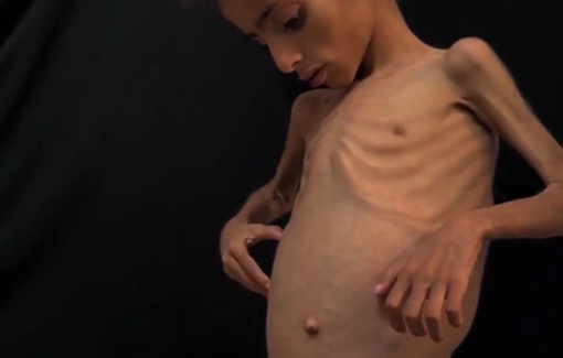 Thumbnail preview image for the video titled: The Israeli siege and genocide have turned the child Osama into a skeleton in Gaza