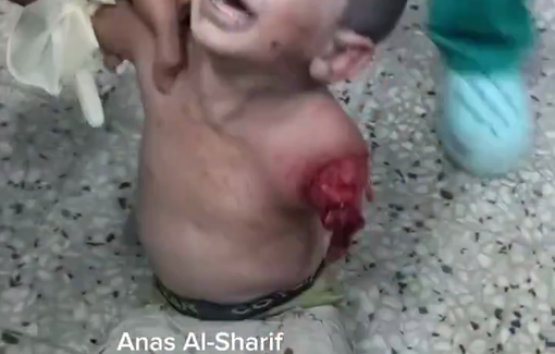 Thumbnail preview image for the video titled: A displaced child sheltering in Al-Qahira School lost his arm in an Israeli airstrike