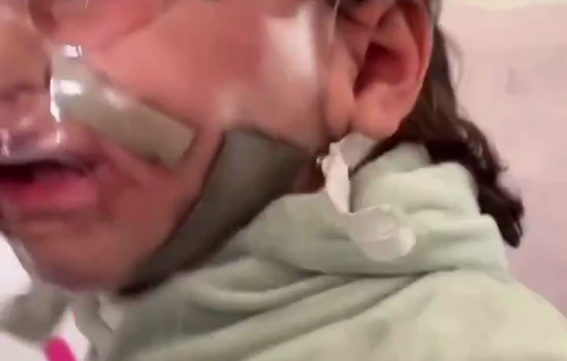 Thumbnail preview image for the video titled: The child Mohammed Hajila is a prisoner of a plastic mask and savage tissue that have disfigured his angelic face
